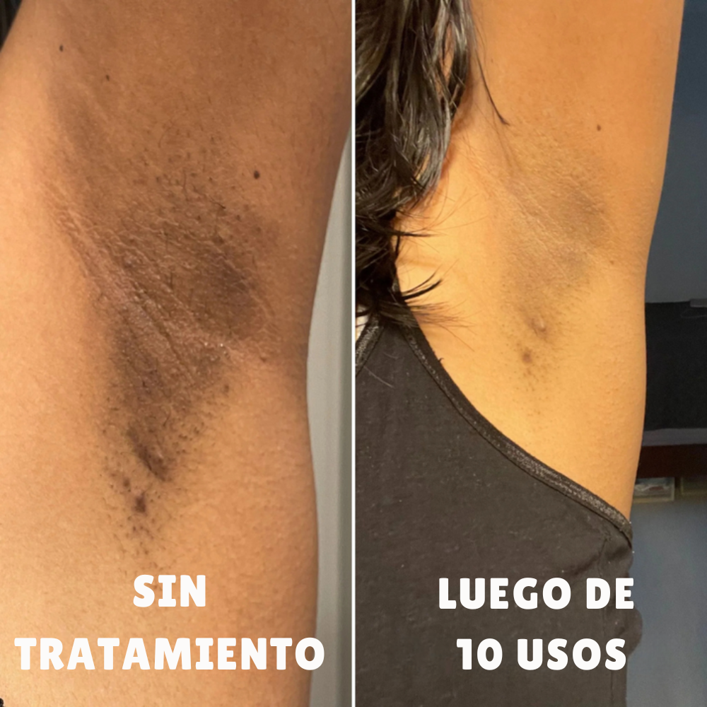 Strawberry – Tratamiento para Manchas y Tono Desigual