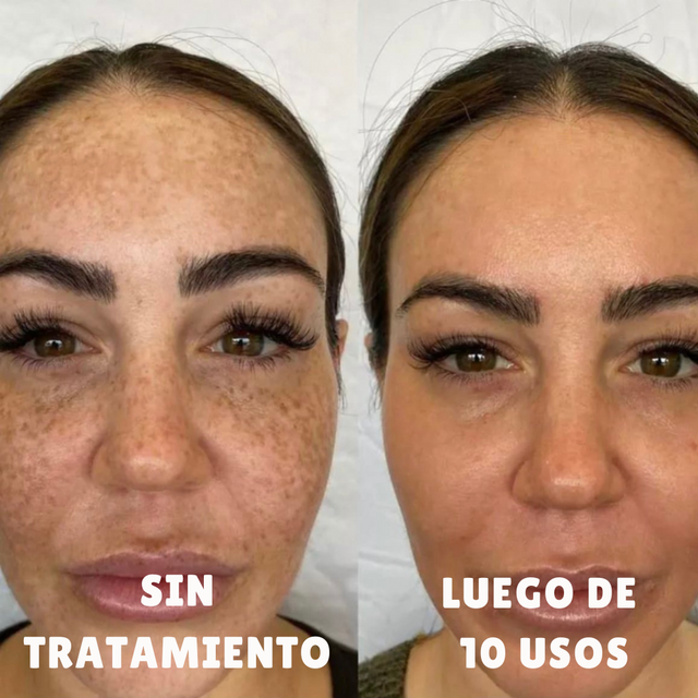 Strawberry – Tratamiento para Manchas y Tono Desigual
