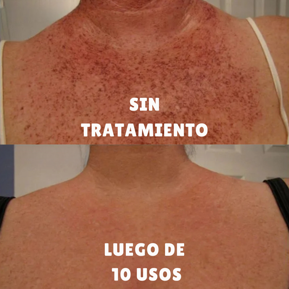 Strawberry – Tratamiento para Manchas y Tono Desigual