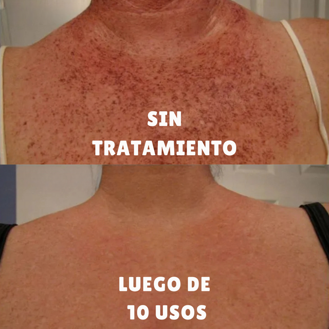 Strawberry – Tratamiento para Manchas y Tono Desigual