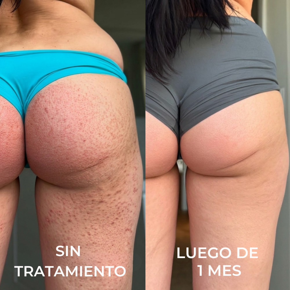 Strawberry Skin – Adiós a la Piel Áspera y los Puntitos Rojos